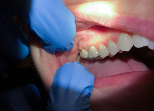 Best Emergency Gum Treatment in Tyhee, ID